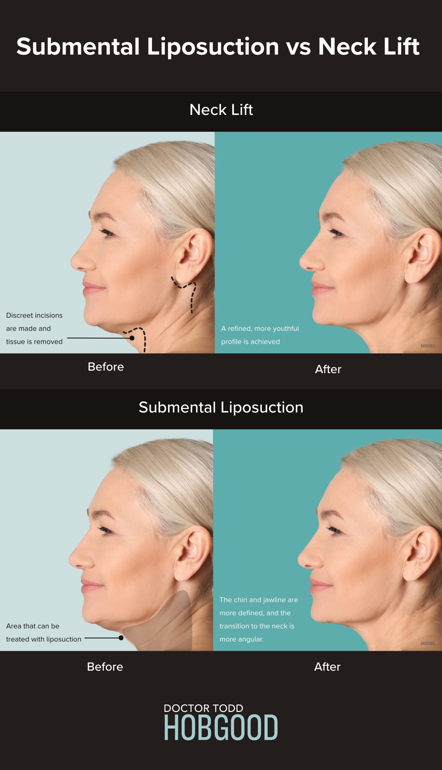 Liposuction, Neck Lift, or Nonsurgical Neck Lift: What's Best for
